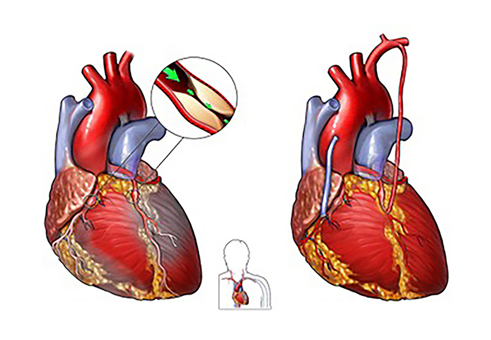 冠動脈バイパス手術のイメージ