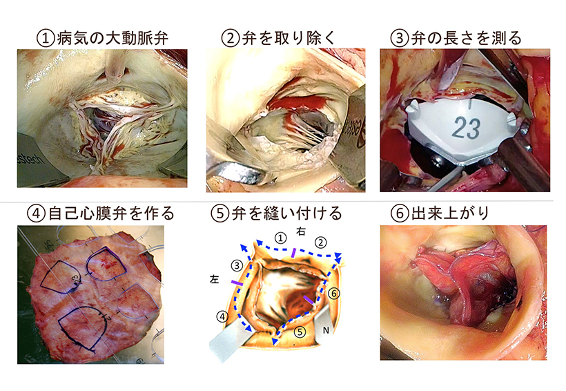 自己心膜による大動脈弁形成術の大動脈弁尖形成手術イメージ2